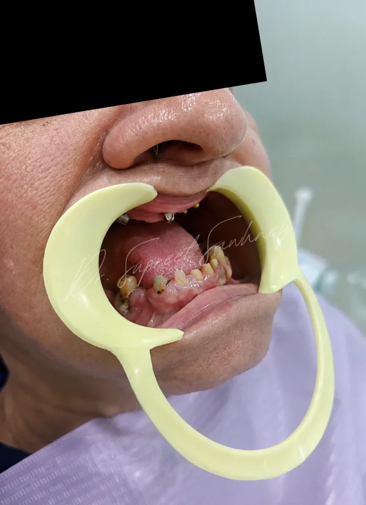 Lateral retracted intraoral photograph showing remaining teeth and implant abutments during rehabilitation